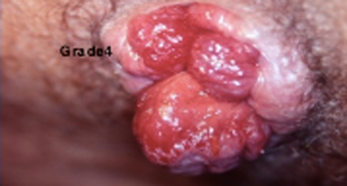 grade4-hemoroide-interne