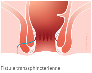 docteur-desantis-fistule-transsphincterienne